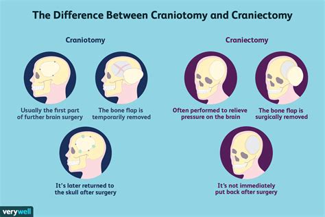 Kraniotomi vs kraniektomi